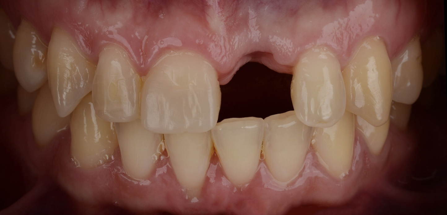 Screenshot 2025-01-02 at 1.01.16 PM Close-up of a person's upper and lower front teeth, showing a significant gap where an upper front tooth is missing—an ideal candidate for dental implants. The gums and surrounding teeth are clearly visible.